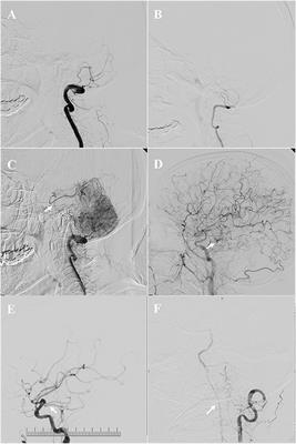 Symptomatic Atherosclerotic Non-acute Intracranial Vertebral Artery Total Occlusion: Clinical Features, Imaging Characteristics, Endovascular Recanalization, and Follow-up Outcomes